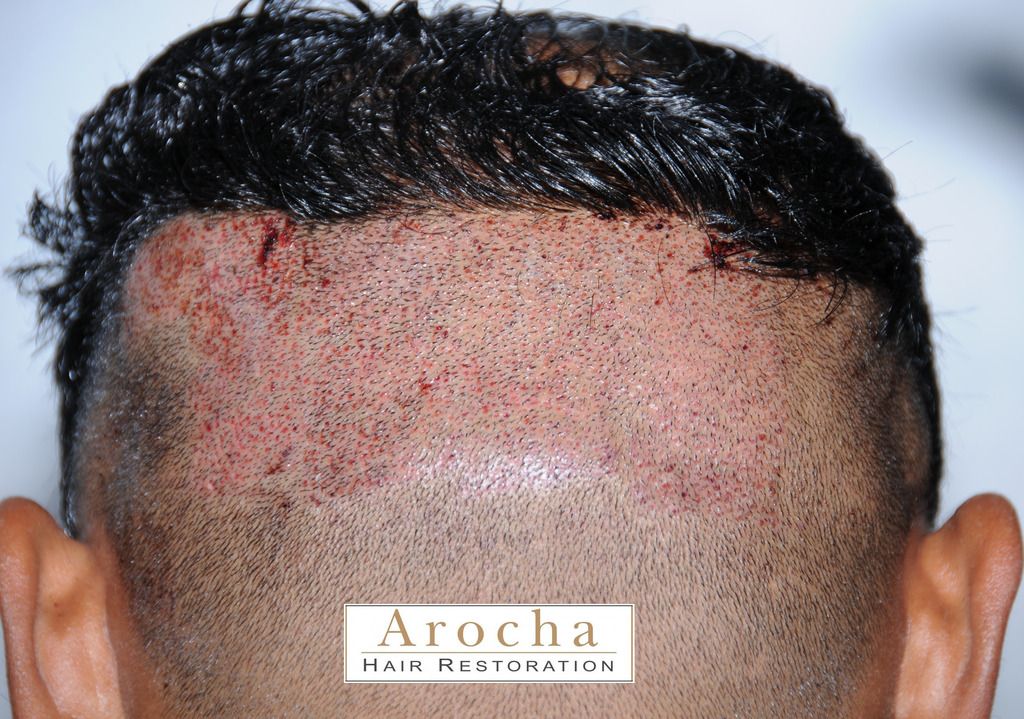 Anything New to the World of Hair Restoration? Hair Restoration